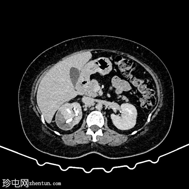 双J支架穿入肾实质