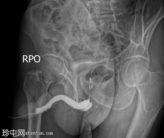 尿道狭窄伴静脉内渗