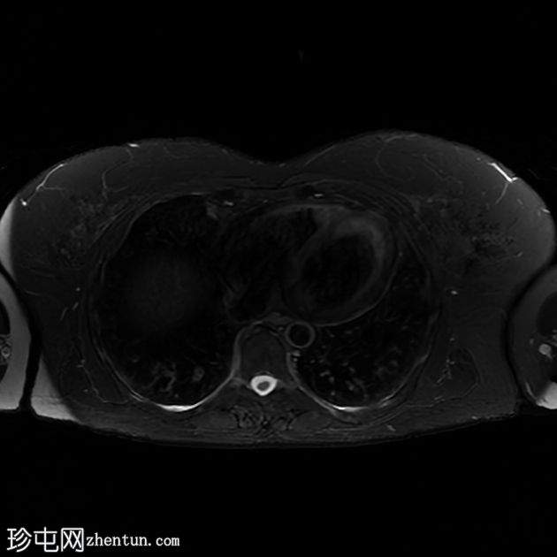 肝血管周围上皮样细胞肿瘤 (PEComa) 