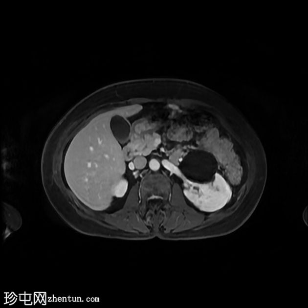 肝血管周围上皮样细胞肿瘤 (PEComa) 