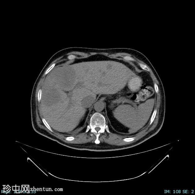 神经内分泌肿瘤-肝脏