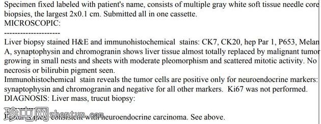 神经内分泌肿瘤-肝脏