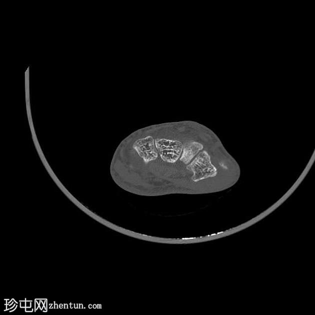 掌骨骨样骨瘤