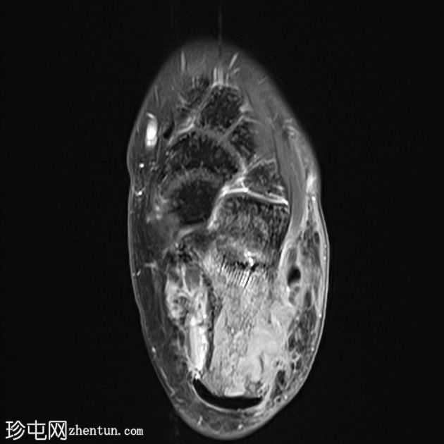 跟骨芽生菌病