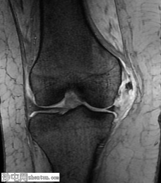 膝关节侧韧带钙化