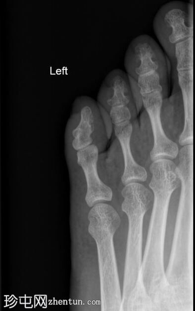 小脚趾联合畸形伴有塔状外骨疣