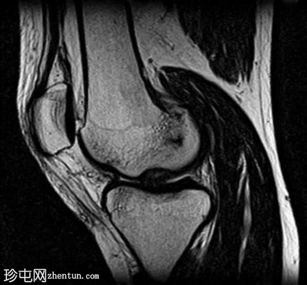 剥脱性骨软骨炎-膝盖