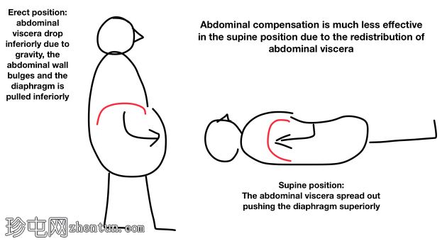 膈肌运动-麻痹的腹部补偿