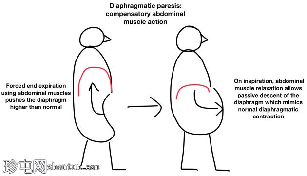 膈肌运动-麻痹的腹部补偿
