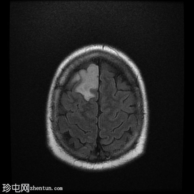 少突胶质细胞瘤