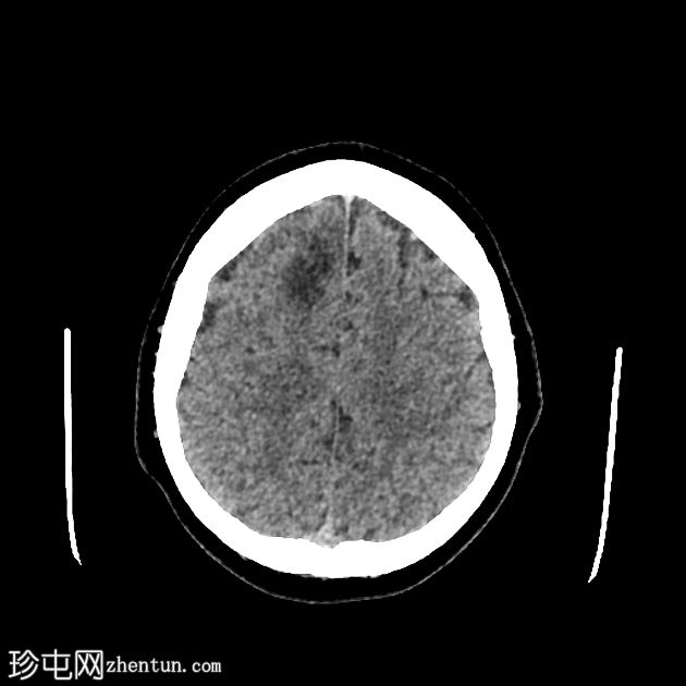 少突胶质细胞瘤