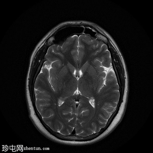 少突胶质细胞瘤