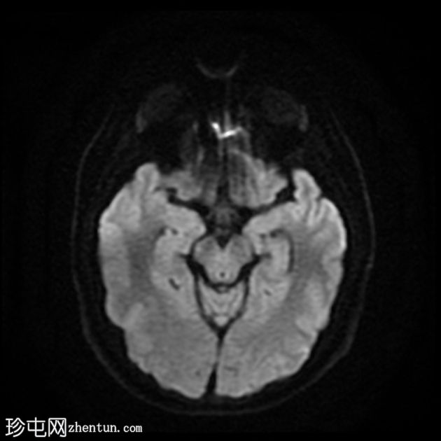 少突胶质细胞瘤