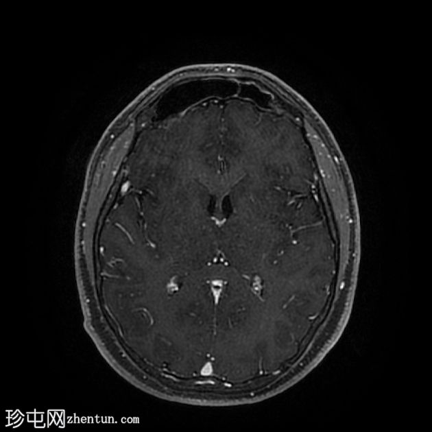 少突胶质细胞瘤