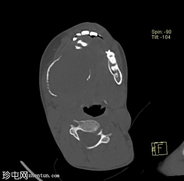 下颌骨纤维增生症