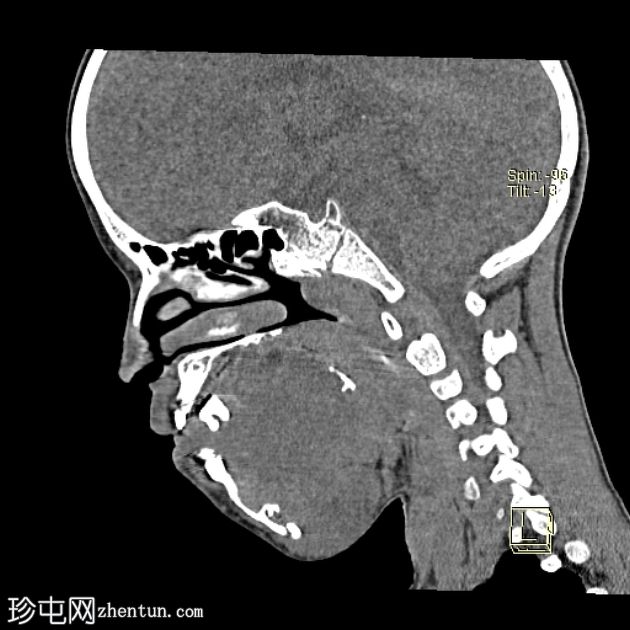 下颌骨纤维增生症