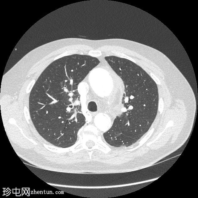 Stanford A型主动脉夹层伴主动脉肺鞘血肿