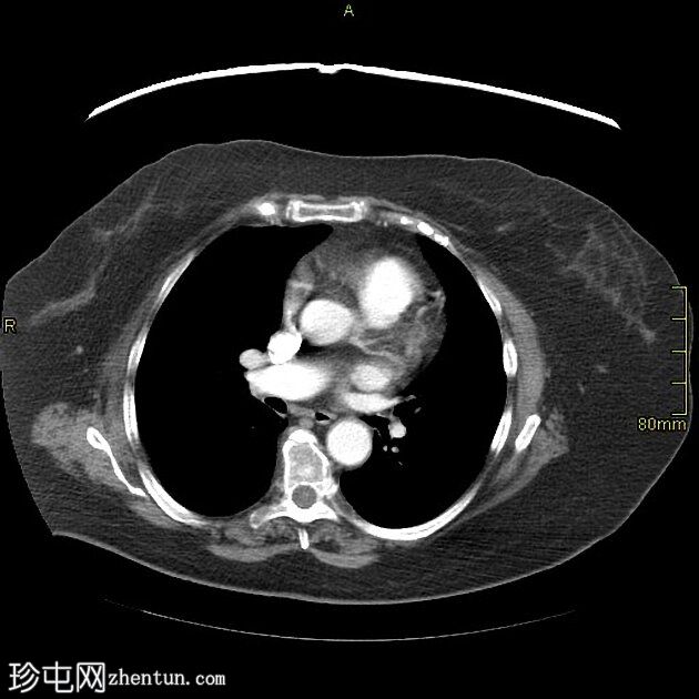 胸骨下甲状腺肿和异位甲状腺