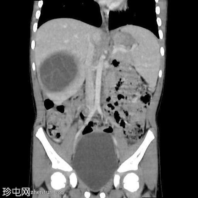 肝包虫囊肿-睡莲征