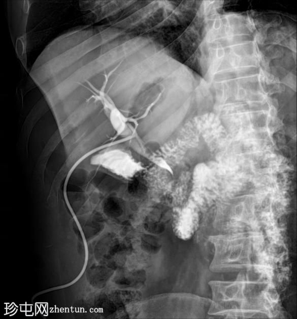 胆总管结石-T管胆管造影
