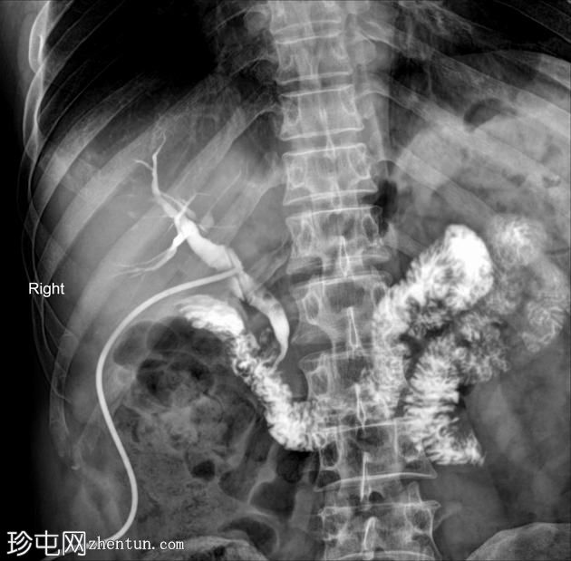 胆总管结石-T管胆管造影