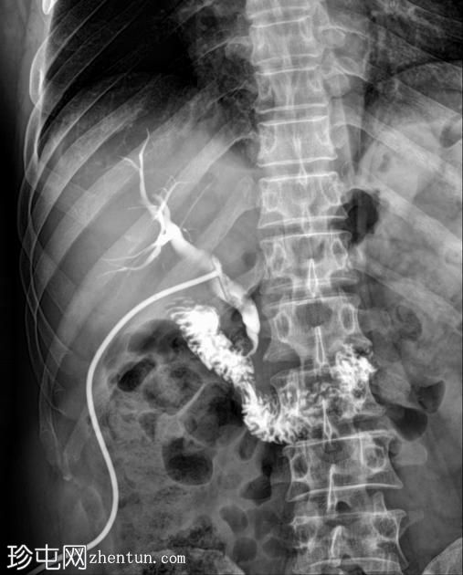胆总管结石-T管胆管造影