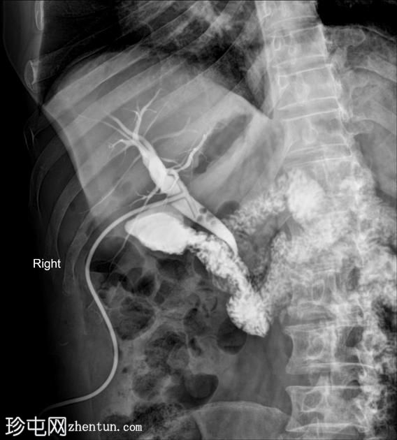 胆总管结石-T管胆管造影