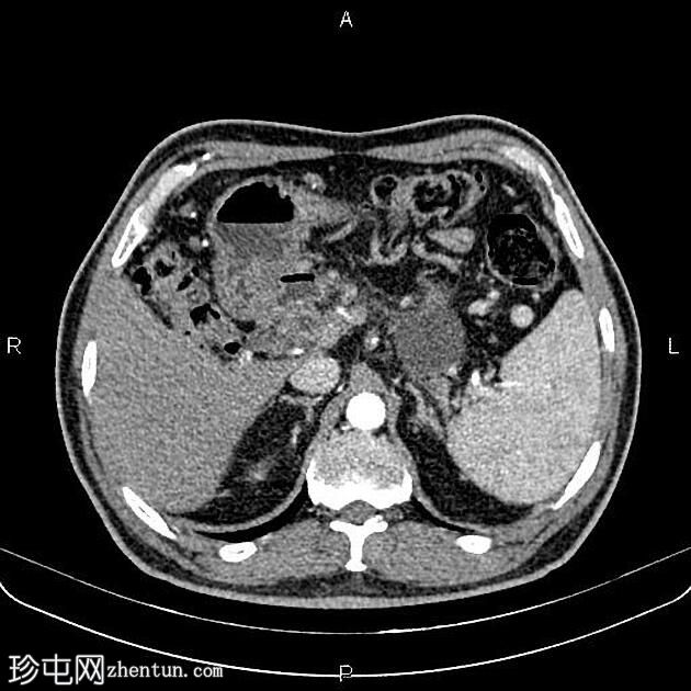 胰腺假性囊肿