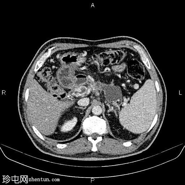 胰腺假性囊肿