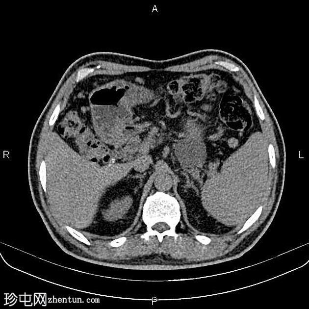 胰腺假性囊肿