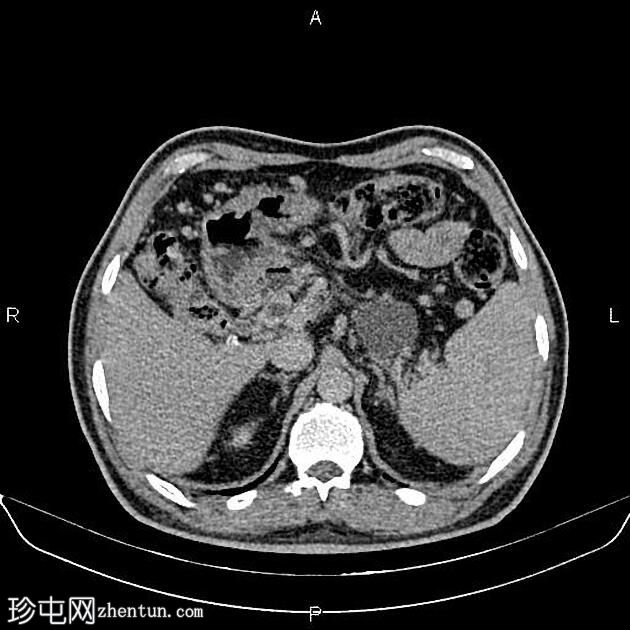 胰腺假性囊肿