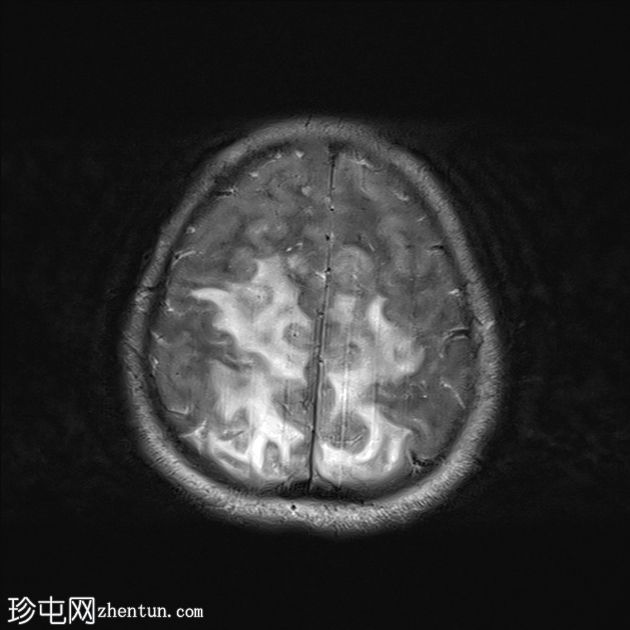 可逆性后部白质病综合征