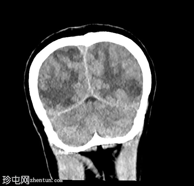 可逆性后部白质病综合征