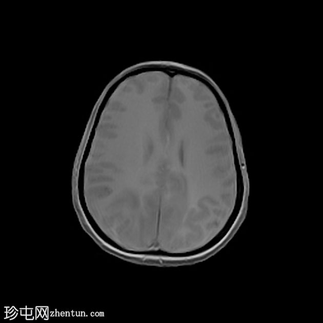 可逆性后部白质病综合征