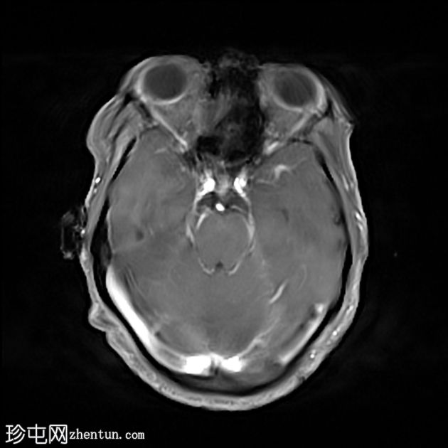 可逆性后部白质病综合征