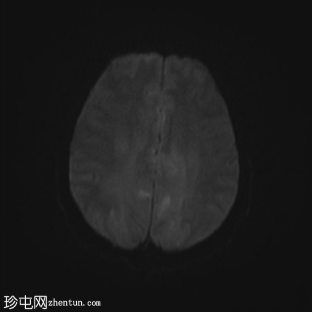 可逆性后部白质病综合征