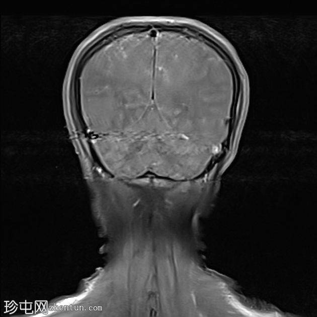 可逆性后部白质病综合征