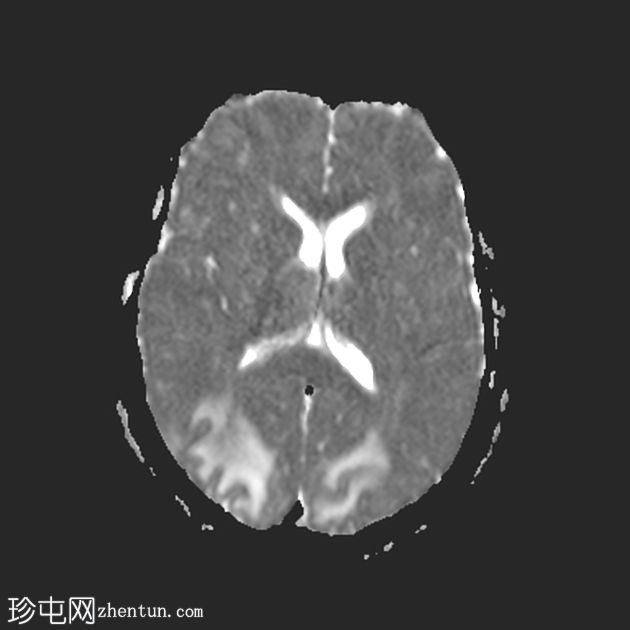 可逆性后部白质病综合征