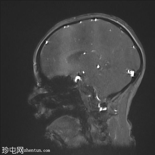 可逆性后部白质病综合征