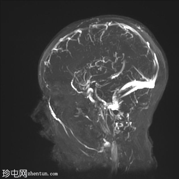 可逆性后部白质病综合征