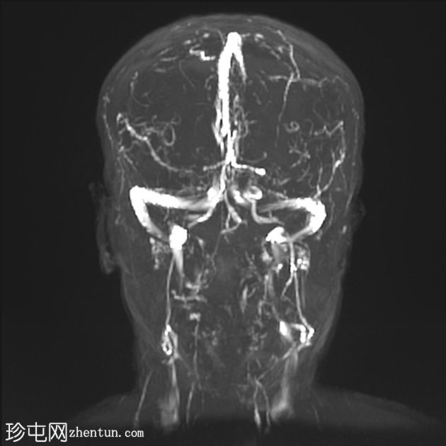 可逆性后部白质病综合征