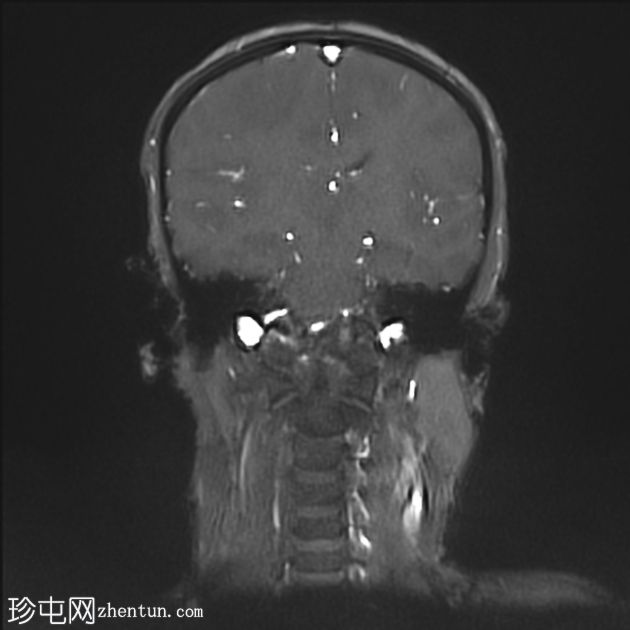 可逆性后部白质病综合征