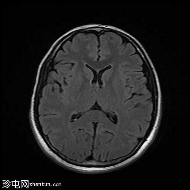 颞叶前部血管周围间隙