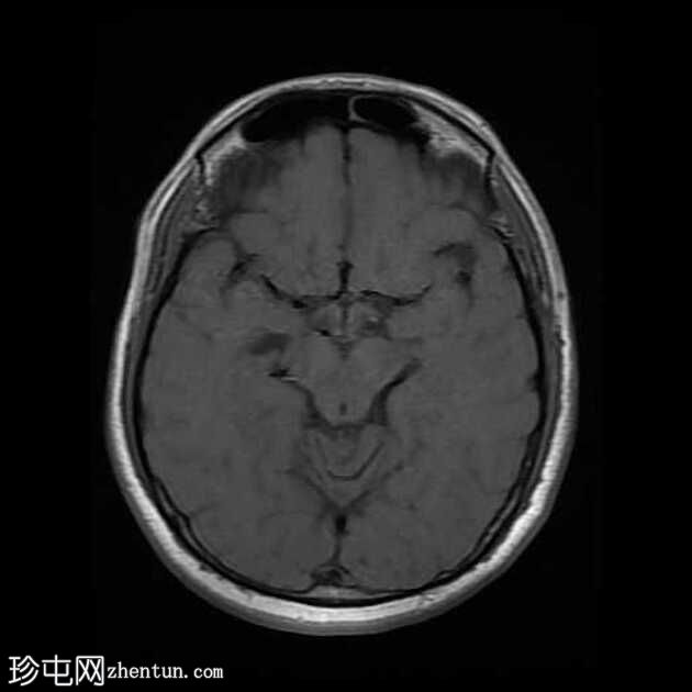 颞叶前部血管周围间隙