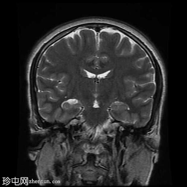 颞叶前部血管周围间隙