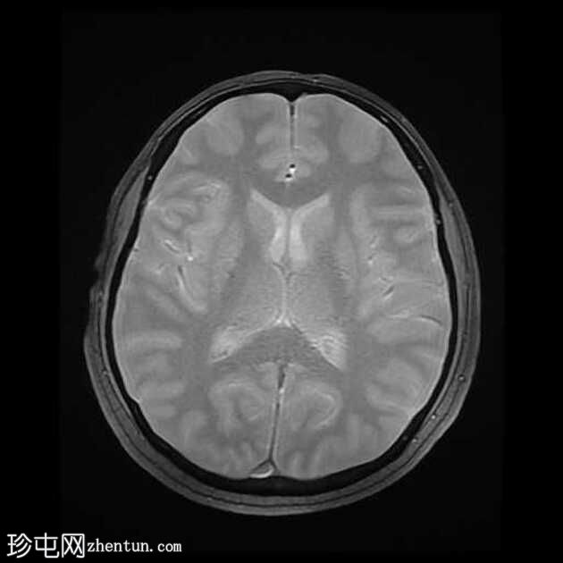 颞叶前部血管周围间隙