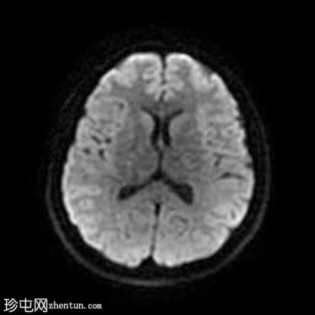 颞叶前部血管周围间隙