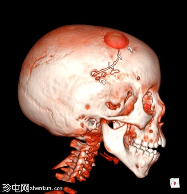 釉质细胞瘤性颅咽管瘤