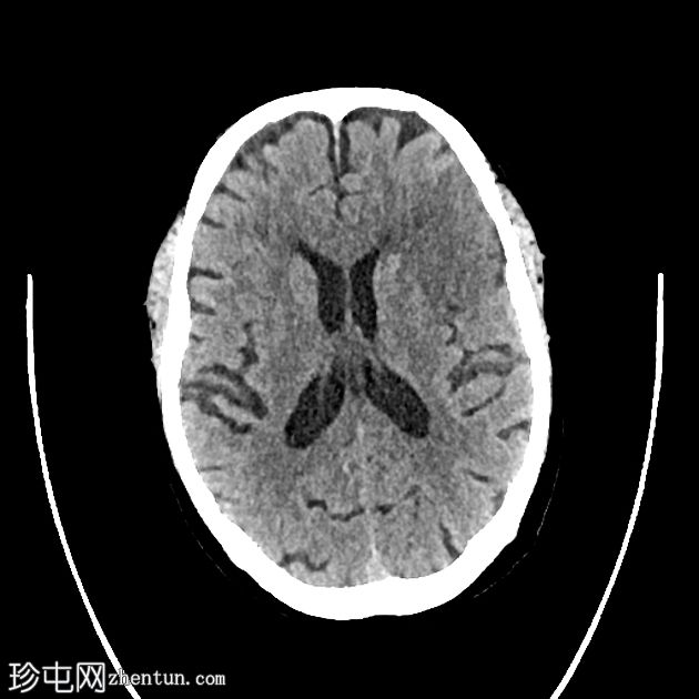 缺血性梗塞出血性转化