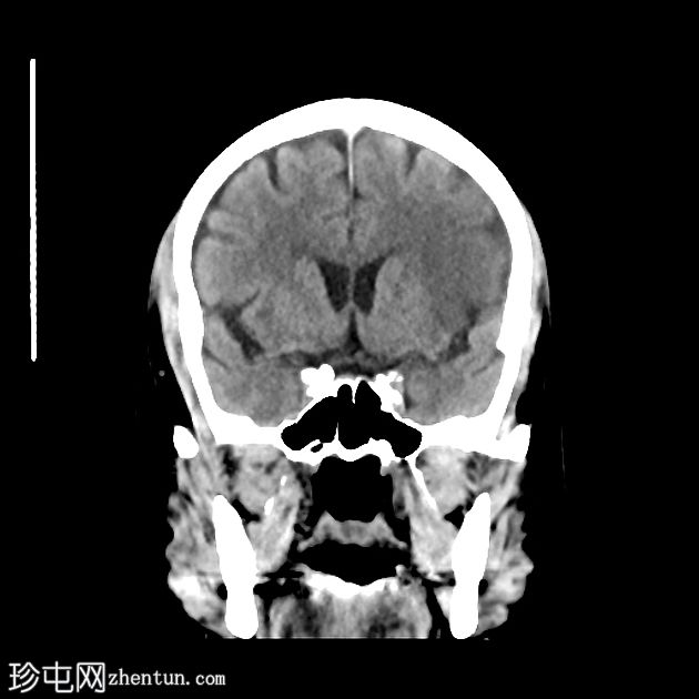 缺血性梗塞出血性转化